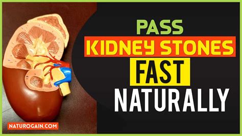 Best Natural Ways To Pass Kidney Stones Herbal Treatment For Kidney