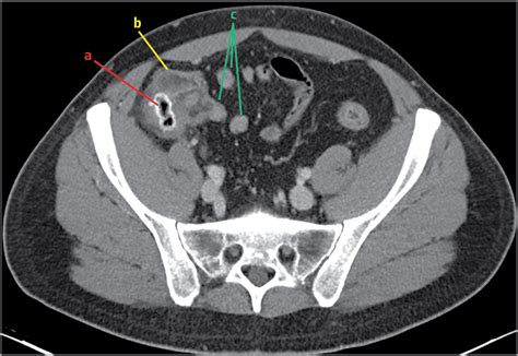 Still Another Case Of Right Lower Quadrant Abdominal Pain Emergency