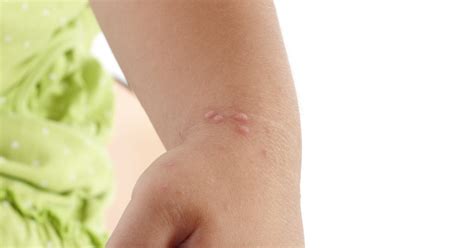 Causes Of A Rash On The Hands Of A Child Livestrongcom
