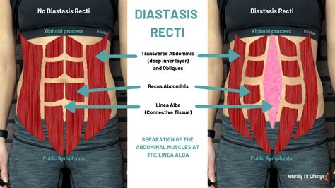 What Is Diastasis Recti Causes Symptoms Treatment Die