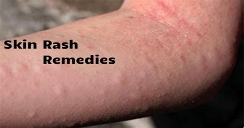 8 Best Natural Remedies For Skin Rashes Skin Helps Pinterest