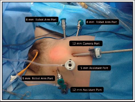 Figure 2 From Robot Assisted Radical Prostatectomy How I Do It Part I