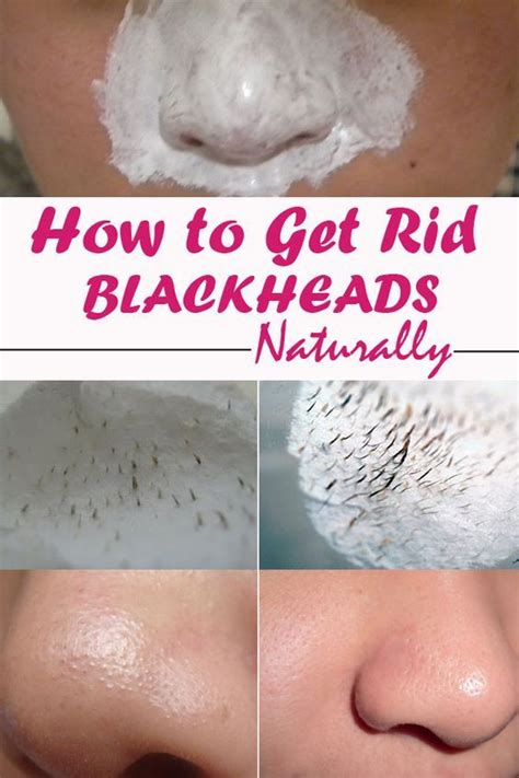How To Get Rid Of Blackheads Naturally Get Rid Of Blackheads