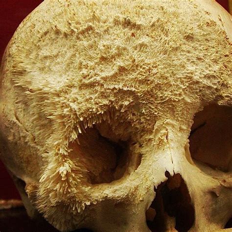 Bone cancer : creepy
