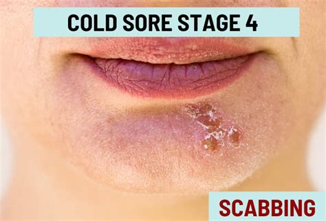 Cold Sore Stages With Pictures
