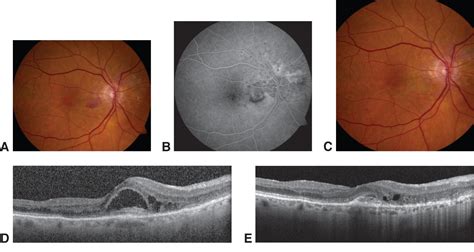 Classic Extrafoveal Cnv American Academy Of Ophthalmology