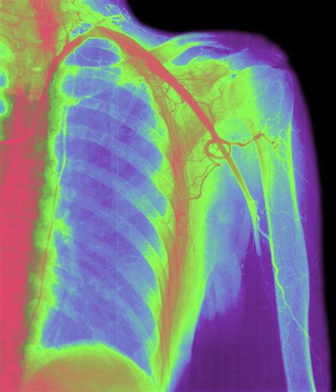 Coloured Angiogram Of Embolus Blocking Arm Artery Photograph By Mehau
