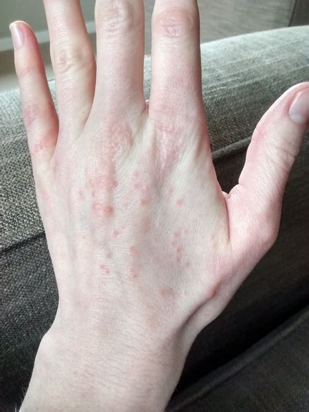 Itchy Red Bumps All Over My Hands Whats Causing Them