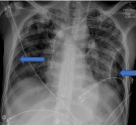 Cureus Infective Endocarditis Induced Lung Injury Mimicking Acute