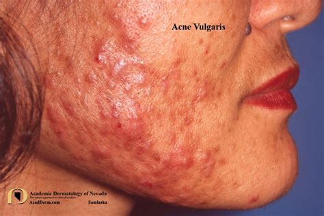 Acne Vulgaris The Good The Bad And The Scarring Academic