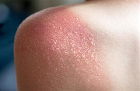 Preventive tips to avoid sunburn. Signs Of Sun Poisoning - Family Magazine