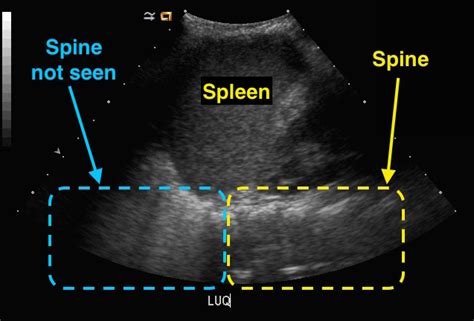 Spine Sign On Ultrasound