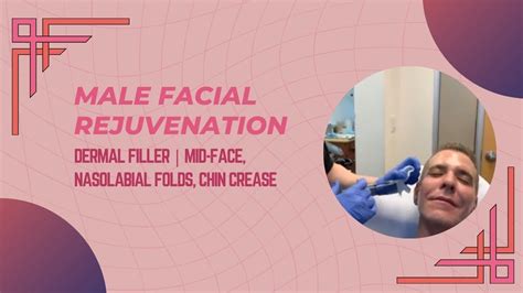 male facial rejuvenation dermal filler mid face nasolabial folds chin crease youtube