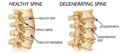 Back Pain And The Ageing Spine Spinal Backrack System