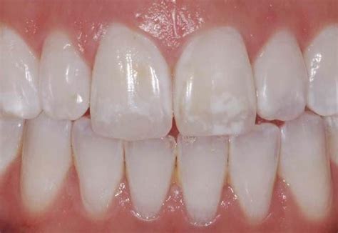 White Spots On Teeth Cause Treatment And Prevention White Spots