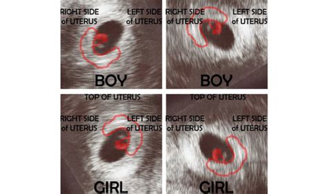 como descobrir o sexo do bebê no primeiro ultrassom método de ramzi