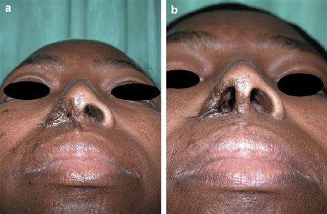A Preoperative View With Ala Scarring And Pinhole Nostril Opening
