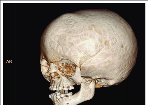 3d Ct Of Skull Showing Fused Coronal Sutures Sagittal Sutures And