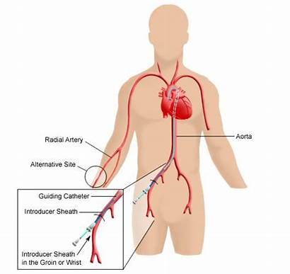 Cardiac Catheterization Femoral Access Heart Catheter Lab