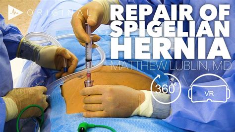 Robotic Spigelian Hernia Repair Dr Matthew Lublin Youtube