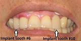 One Day Dental Implants Chicago Images
