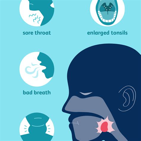 Chronic And Recurrent Tonsillitis What To Know