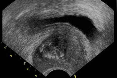 Ecografía Transrectal Blogs Quirónsalud