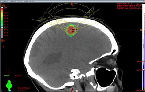 Stereotactic Radiosurgery Targets Metastatic Brain Tumors North