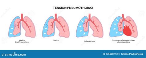 Tension Pneumothorax Poster Cartoon Vector 275372085