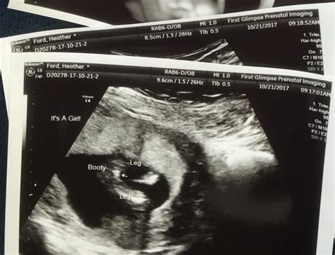 14 Week Ultrasound Early Gender Determination Babycenter