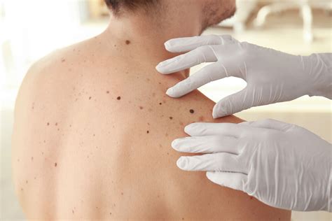 Skin Cancer Screening — Fora Dermatology General And Surgical