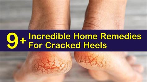 9 Incredible Home Remedies For Cracked Heels