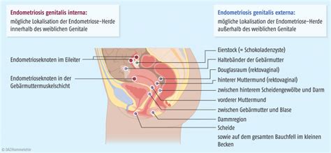 .endometriosis genitalis interna (innere genitale endometriose), die endometriosis genitalis externa (äußere genitale endometriose) und die endometriosis extragenitalis (extragenitale. Pharmakotherapie der Endometriose