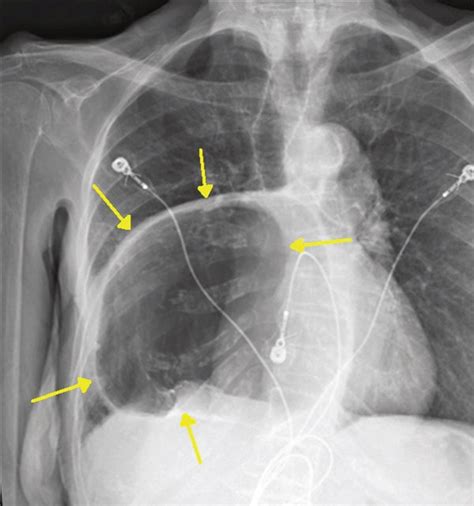 Upright Chest X Ray Showing Large Intrathoracic Hiatal Hernia Between