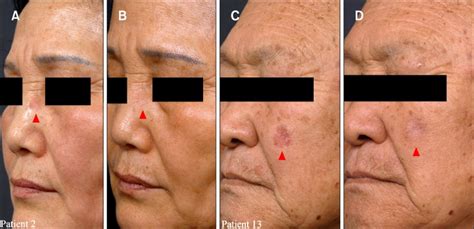 Actinic Keratosis Face Treatment Doctor Heck