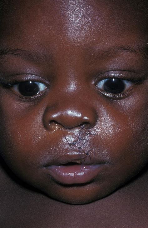 Cleft Lip Photograph By Dr Ma Ansaryscience Photo Library