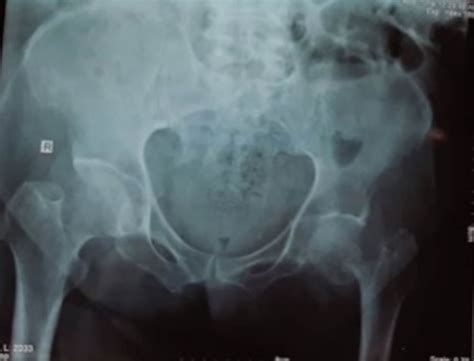 Total Hip Replacement In Patient With Residual Poliomyelitis With