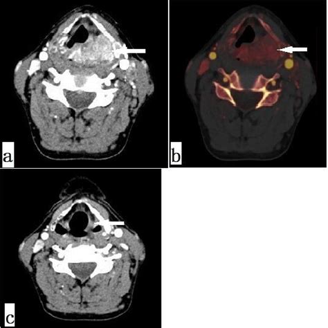 Figure 1 From Dual Energy Ct Iodine Map In Predicting The E Cacy Of