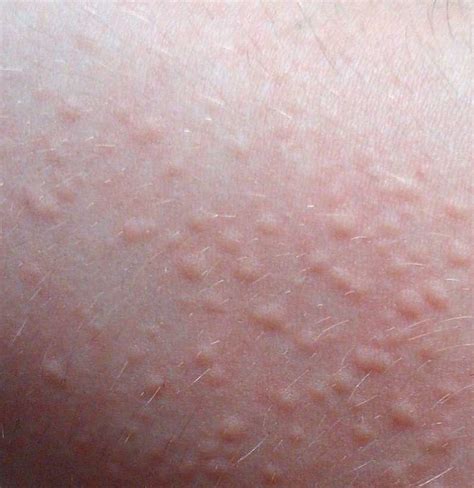 Urticaria Hives Causes Symptoms Diagnosis And Treatment Dark Brown Hairs