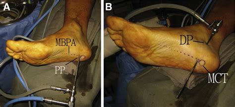 Endoscopic Decompression Of The First Branch Of The Lateral Plantar