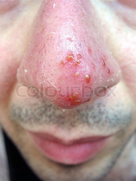 A Medical Condition Closeup Of The Common Coldsore Virus Herpes Simplex