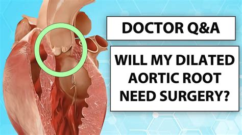 Doctor Qanda The Progression And Surgery Of Dilated Aortic Root