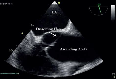 Spontaneous Aortic Dissection Limited To The Sinus Of Valsalva Report