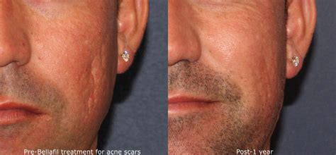 Scar And Acne Scar Treatment San Diego Ca Clderm