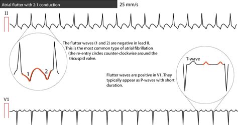 Atrial Flutter Classification Causes Ecg Diagnosis And Management