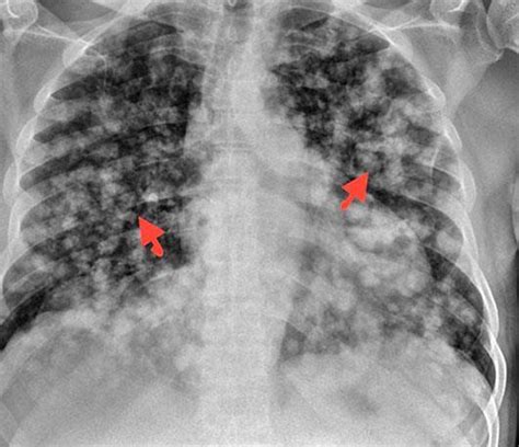 Chest X Ray Showing Multiple Nodules Of Various Sizes In Both Lung