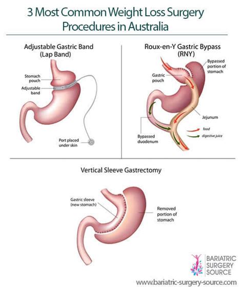 Weight Loss Surgery Australia All You Need To Know Bariatric