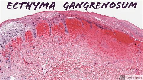 Ecthyma Gangrenosum 5 Minute Pathology Pearls Youtube