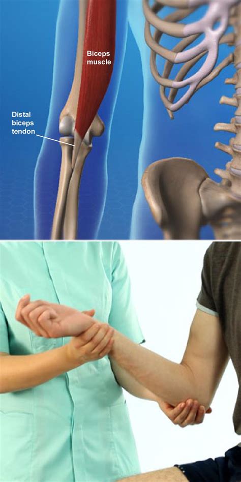 Inflammation Of The Biceps Tendon At The Elbow Orthopaedic Associates