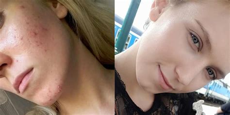 The Internet Is Losing It Over This Before And After Acne Photo